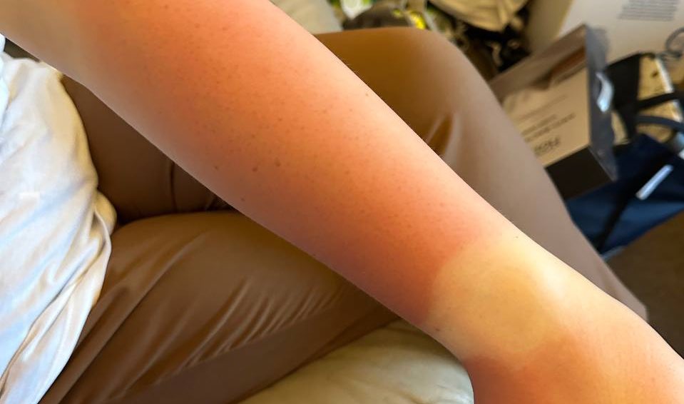 I GOT SUNBURNT IN THE FREAKING UK. How is that possible I was completely fine in my home country in 35 degrees, but here 😭😭😭 everyone is gonna think I was in Greece or sth 😭
