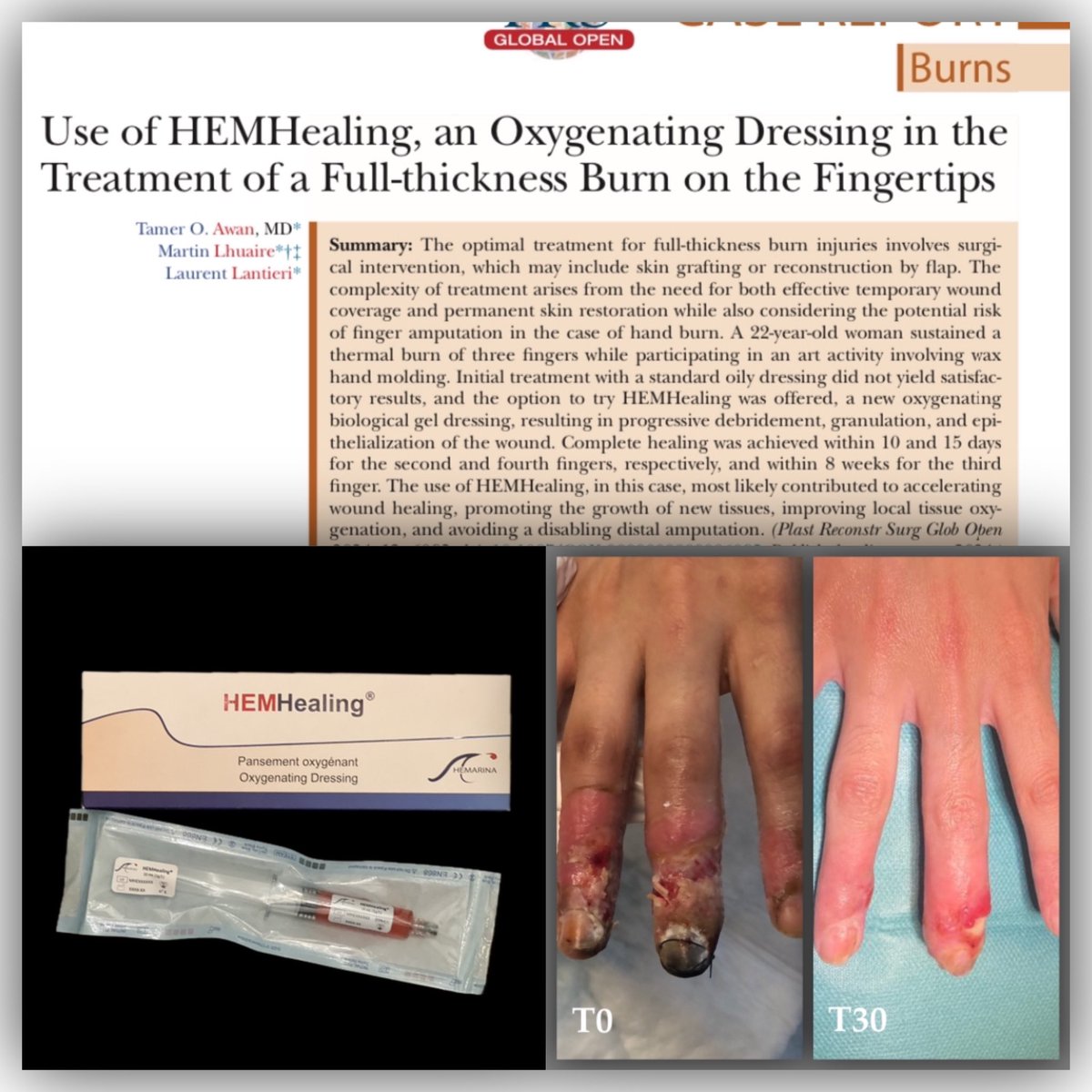 Thank you to ANSM  which provide us the compassional use of #HEMHealing, a breakthrough oxygenating dressing, which contributed to accelerating wound healing, improving local tissue oxygenation, and avoiding a disabling distal amputation to a young patient of 22 years old. #wound
