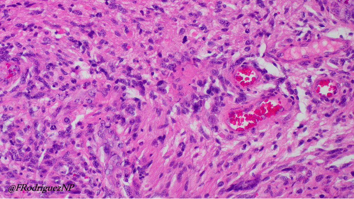 FRodriguezNP's tweet photo. 60 y/w with enhancing mass involving the frontal lobe. Satisfies criteria for #glioblastoma, and additionally #MMR  protein loss (MSH2/MSH6). This diagnosis should be considered in diffuse gliomas with giant cells, particularly when developing in young patients. But learning that the clinicopathologic spectrum is wider. In this case the giant cells are scant and the patient is in a older age group. #Neuropath #Neuroonc #braintumor