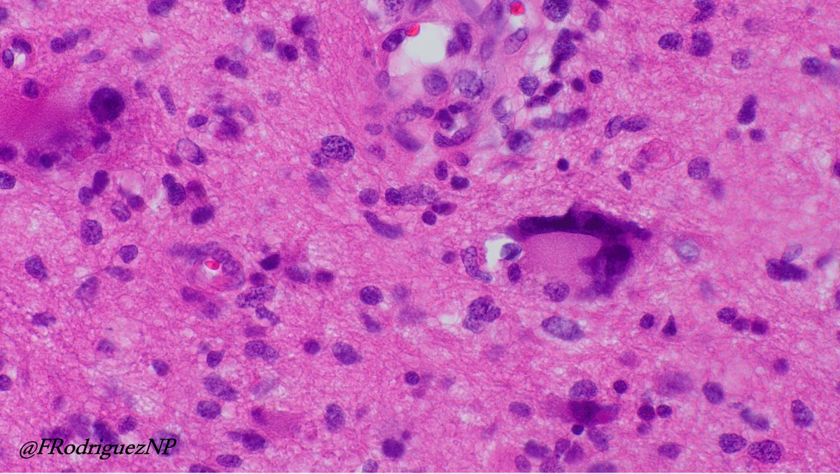 FRodriguezNP's tweet photo. 60 y/w with enhancing mass involving the frontal lobe. Satisfies criteria for #glioblastoma, and additionally #MMR  protein loss (MSH2/MSH6). This diagnosis should be considered in diffuse gliomas with giant cells, particularly when developing in young patients. But learning that the clinicopathologic spectrum is wider. In this case the giant cells are scant and the patient is in a older age group. #Neuropath #Neuroonc #braintumor