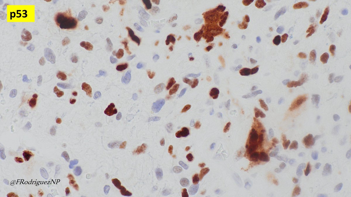 FRodriguezNP's tweet photo. 60 y/w with enhancing mass involving the frontal lobe. Satisfies criteria for #glioblastoma, and additionally #MMR  protein loss (MSH2/MSH6). This diagnosis should be considered in diffuse gliomas with giant cells, particularly when developing in young patients. But learning that the clinicopathologic spectrum is wider. In this case the giant cells are scant and the patient is in a older age group. #Neuropath #Neuroonc #braintumor