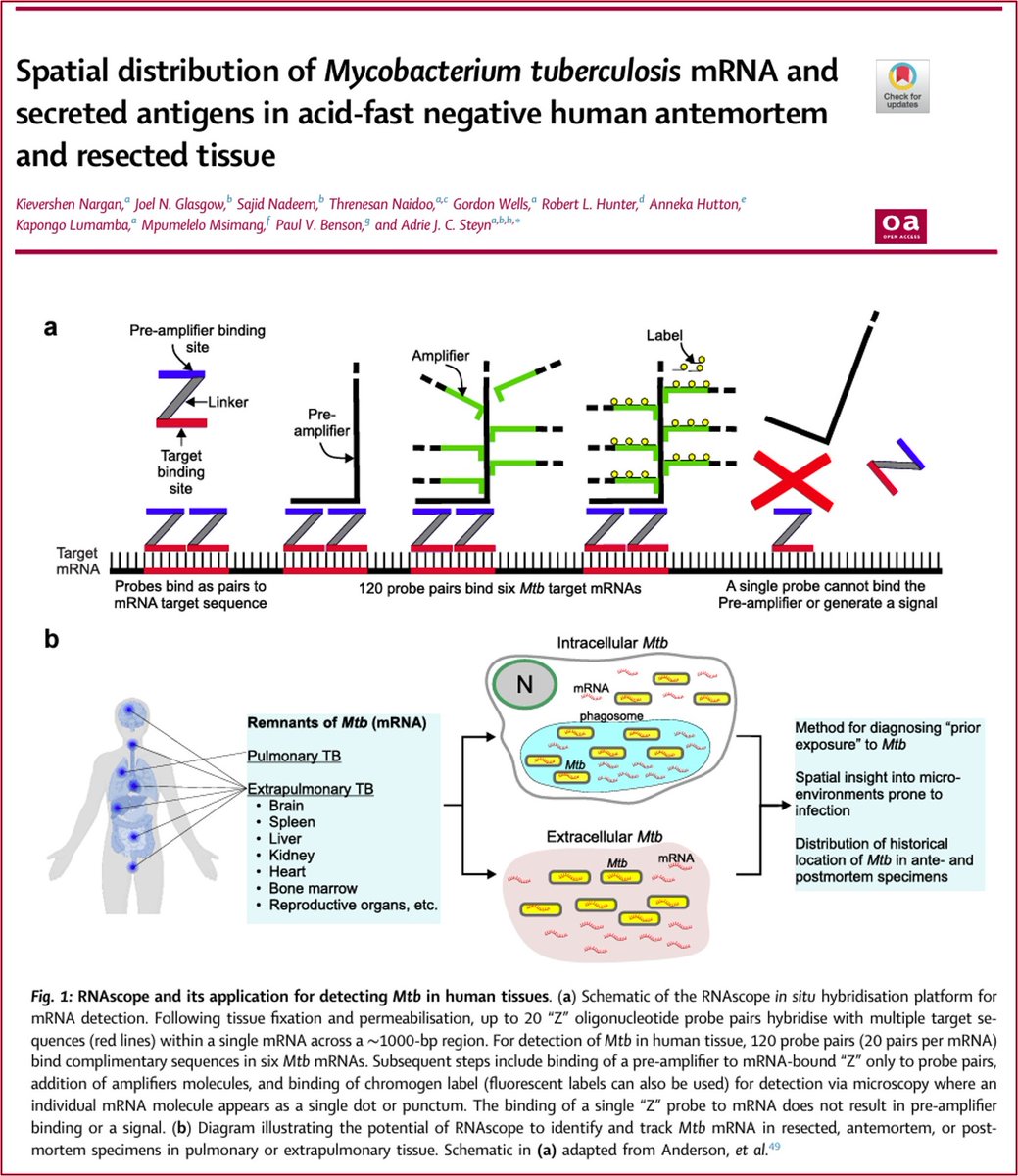 Steyn Lab (@steyntblab) on Twitter photo 🚨Published <a href="/eBioMedicine/">eBioMedicine – The Lancet Discovery Science</a> A new approach to study #Mtb physiology & #TB diagnosis. Our study uses #RNAscope to detect #Mycobacterium #tuberculosis mRNA in human tissue, even when traditional ZN staining fails. <a href="/UABMicrobiology/">UAB Microbiology</a> <a href="/AHRI_News/">Africa Health Research Institute</a> <a href="/UABPathology/">UAB Pathology</a> thelancet.com/journals/ebiom… 🚨Published <a href="/eBioMedicine/">eBioMedicine – The Lancet Discovery Science</a> A new approach to study #Mtb physiology & #TB diagnosis. Our study uses #RNAscope to detect #Mycobacterium #tuberculosis mRNA in human tissue, even when traditional ZN staining fails. <a href="/UABMicrobiology/">UAB Microbiology</a> <a href="/AHRI_News/">Africa Health Research Institute</a> <a href="/UABPathology/">UAB Pathology</a> thelancet.com/journals/ebiom…
