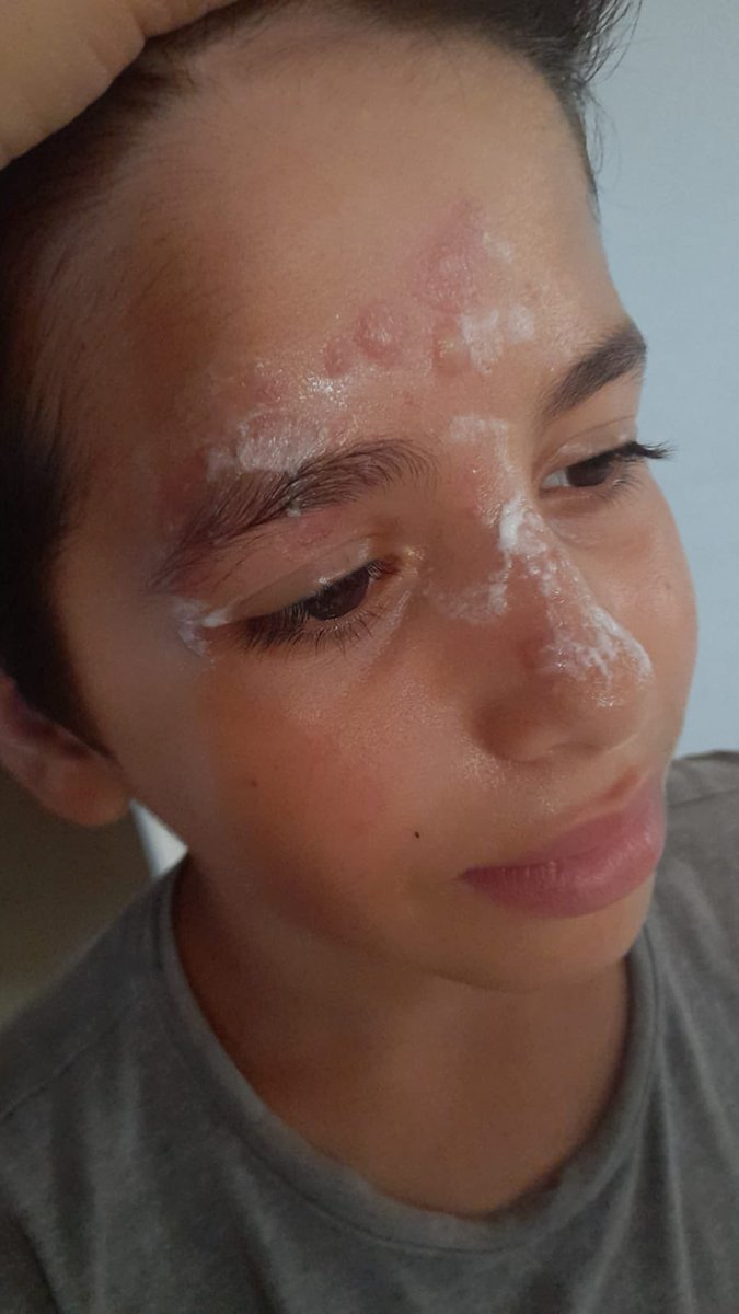 UPDATE: the kids are getting WORSE!! 

their treatment isn’t working, they can’t stay in this weather!! PLEASE HELP WAFA AND HER CHILDREN EVACUATE!!!

SHORT GOAL: 500$

GFM: gofund.me/c9ac662f