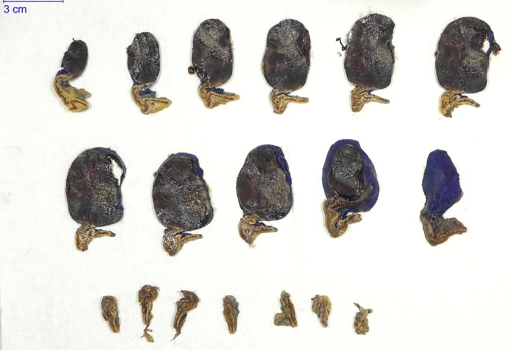 slusagar's tweet image. #endopath:

adrenal myelolipoma