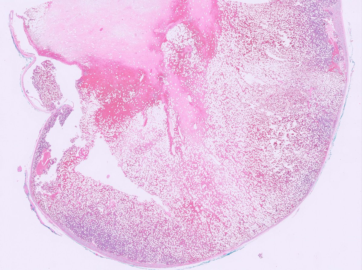 slusagar's tweet image. #endopath:

adrenal myelolipoma