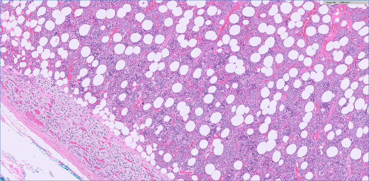 slusagar's tweet image. #endopath:

adrenal myelolipoma