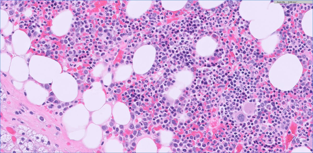slusagar's tweet image. #endopath:

adrenal myelolipoma