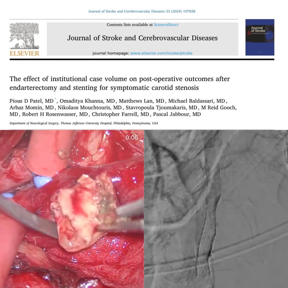 The more you do the better you get at it !Our rising star resident <a href="/piouspatel/">Pious Patel</a> reviewed 5873 patients treated :
Hospitals performing higher volumes of CEA(&gt;30)or CAS(&gt;10) annually have fewer postoperative strokes (6.0% vs 11.7%) and (1.4% vs 11.0%)<a href="/TJUHNeurosurg/">Jefferson Neurosurgery</a> <a href="/TJUHospital/">Jefferson Health</a>