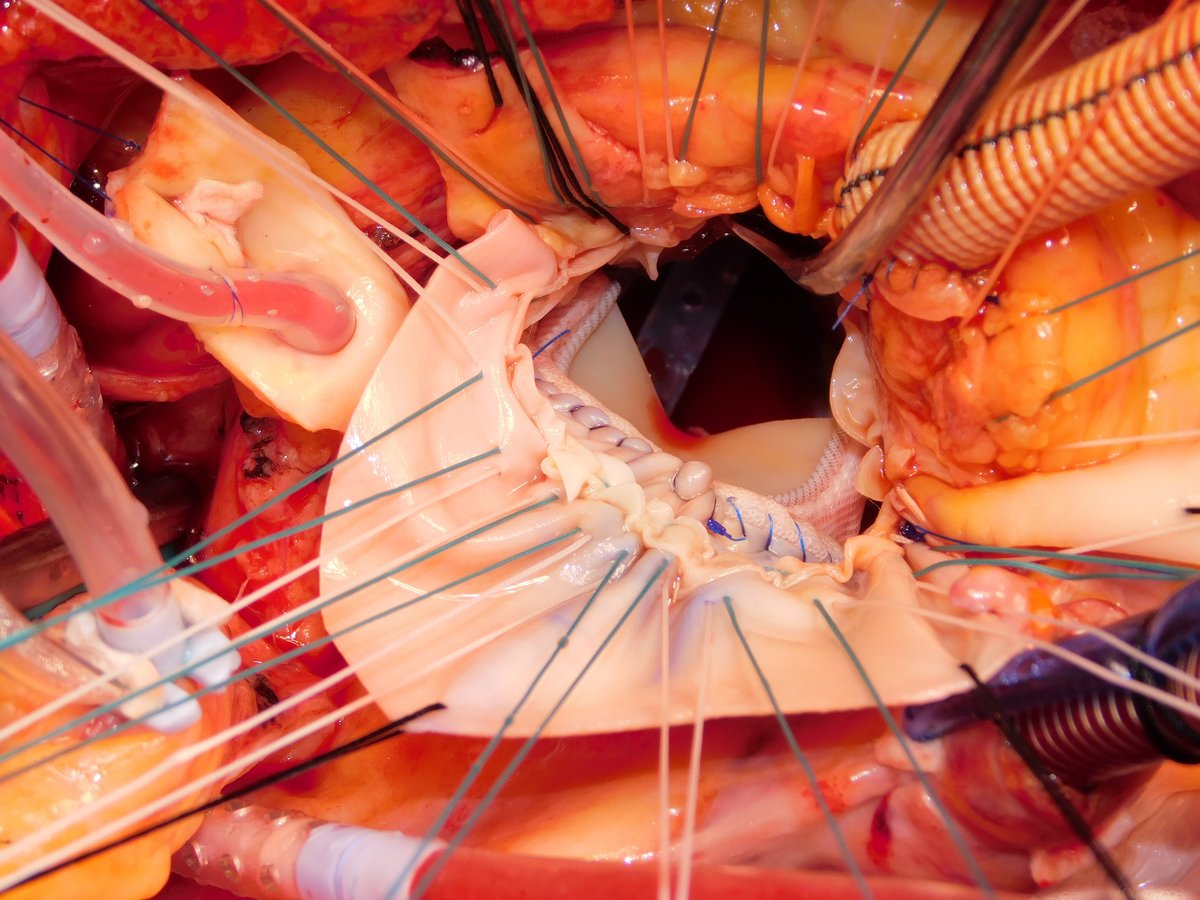triplevalve's tweet photo. TAVR explant is the fastest growing cardiac surgical operation. Some cases require radical debridement of the aortomitral curtain. Check out our approach to this @lenoxhill.

https://t.co/2u062iVhai https://t.co/lTh4HrPv2k