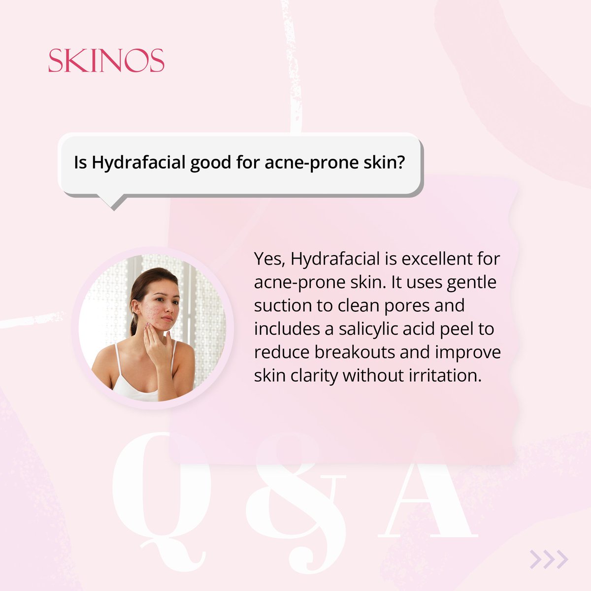 skinosclinic's tweet image. Experience clear, glowing skin with Hydrafacial! Dive into our FAQ post to learn how Hydrafacial can benefit acne-prone skin. Get all your questions answered and discover the secret to radiant, acne-free skin! ✨💧 

#Hydrafacial #AcneFreeSkin #SkincareFAQ #Skinos #DrShrutiGupta