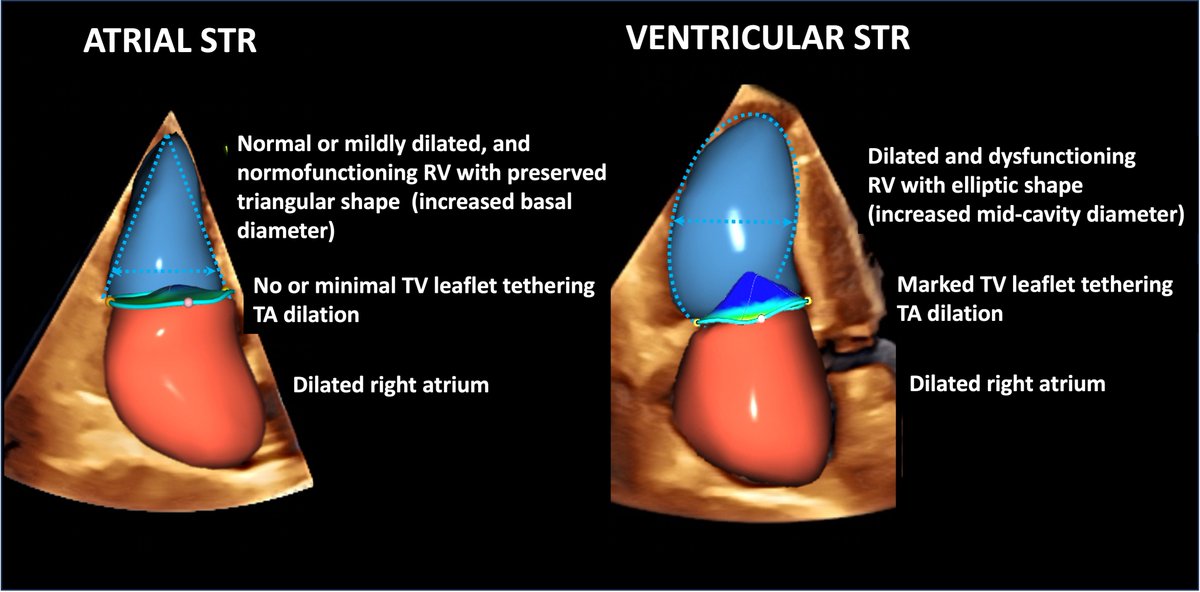 Michele Tomaselli (@michetomaselli) on Twitter photo Check out our latest review on #JASE about the strengths and limitations of echocardiographic parameters in assessing patients with TR before and after interventions. Great collaborative effort! onlinejase.com/article/S0894-…
<a href="/lpbadano/">Luigi</a>
<a href="/denisamuraru/">Denisa Muraru</a>
<a href="/NAjmoneMarsan/">Nina Ajmone Marsan</a>
<a href="/XGalloo/">GallooX</a>
<a href="/CHPedroLi/">CH. Pedro Li</a> Check out our latest review on #JASE about the strengths and limitations of echocardiographic parameters in assessing patients with TR before and after interventions. Great collaborative effort! onlinejase.com/article/S0894-…
<a href="/lpbadano/">Luigi</a>
<a href="/denisamuraru/">Denisa Muraru</a>
<a href="/NAjmoneMarsan/">Nina Ajmone Marsan</a>
<a href="/XGalloo/">GallooX</a>
<a href="/CHPedroLi/">CH. Pedro Li</a>