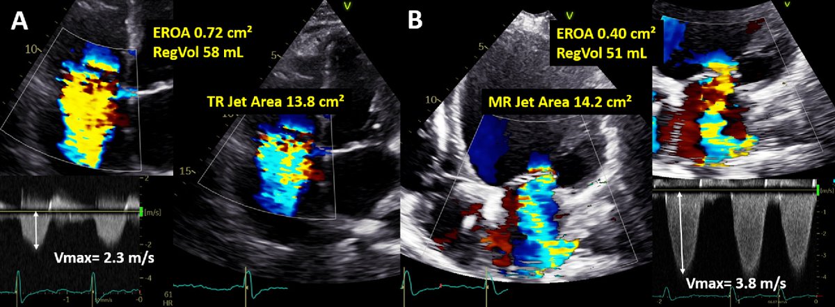 michetomaselli's tweet photo. Check out our latest review on #JASE about the strengths and limitations of echocardiographic parameters in assessing patients with TR before and after interventions. Great collaborative effort! https://t.co/kRJRxpNhyh
@lpbadano
@denisamuraru
@NAjmoneMarsan
@XGalloo
@CHPedroLi https://t.co/YJAclqvuZa