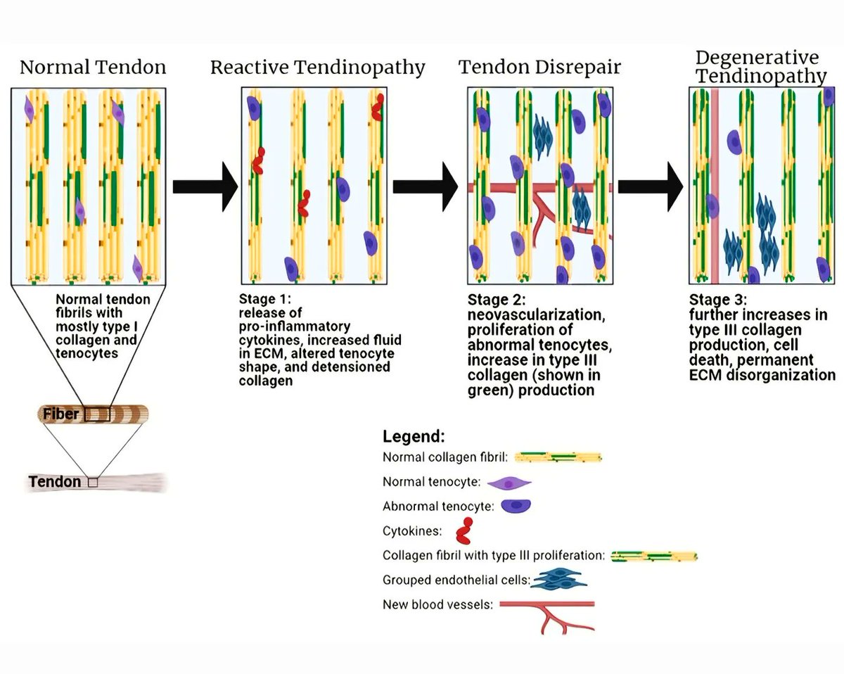 〽️ 'Tendon continuum' is a new strategy proposed by J L Cook and C R Purdam for approaching tendon pain and pathologies.

There are 3 stages to this continuum: 

[1] Reactive tendinopathy
[2] Tendon disrepair
[3] Degenerative tendinopathy