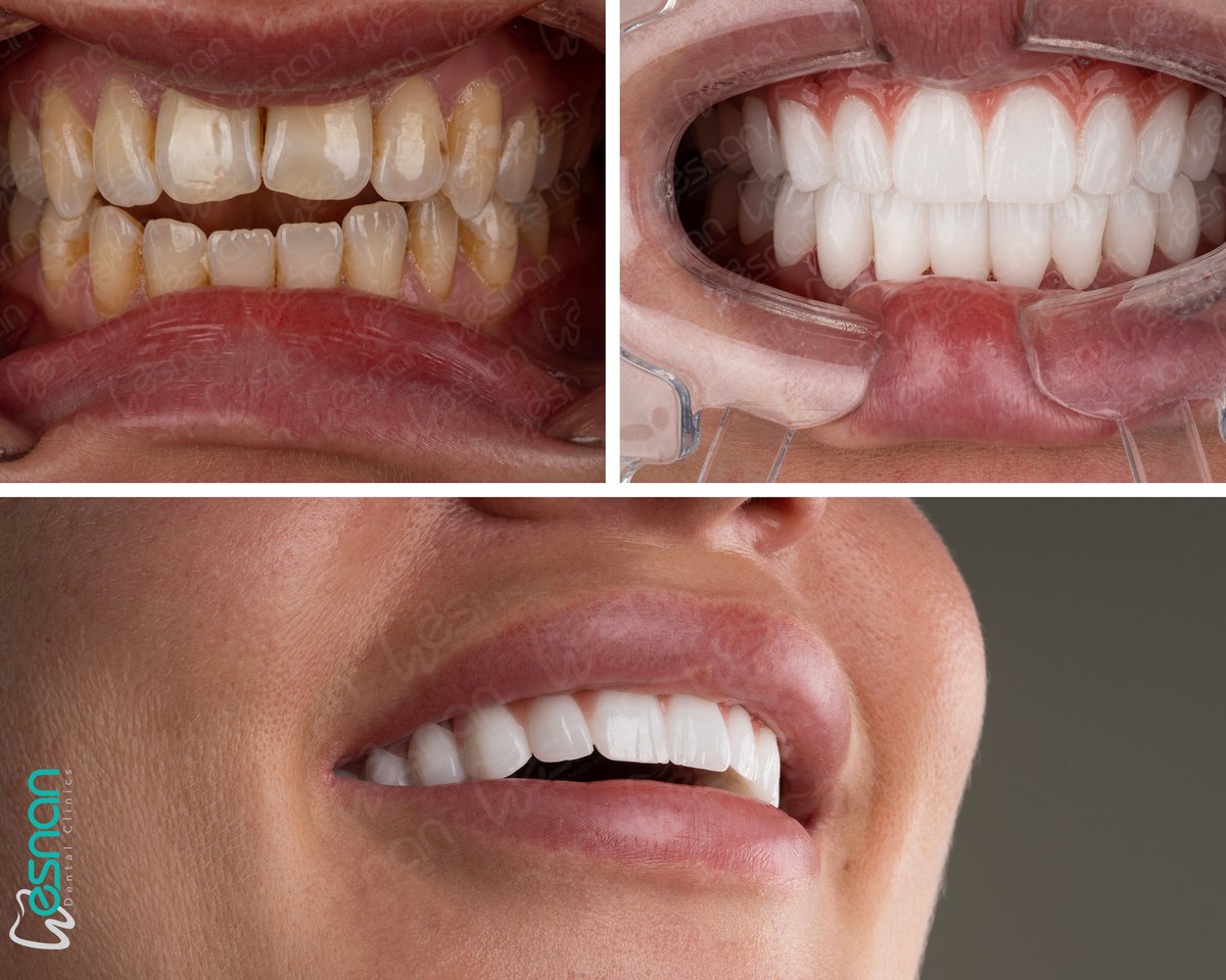 esnanclinics's tweet image. Experiencing an open bite problem? At Esnan Dental Clinics, our expert dentists effectively treat this issue. 🦷✨

 esnandentalclinics.com 

#dental #openbite #zirconia #dentalhealth