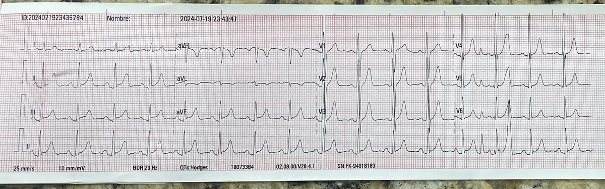 Victor_FragaE's tweet photo. - Sin respuesta a maniobras vágales.
- Se administran 6 mg de adenosina IV y se obtiene el siguiente EKG https://t.co/pM5U2tDpNm