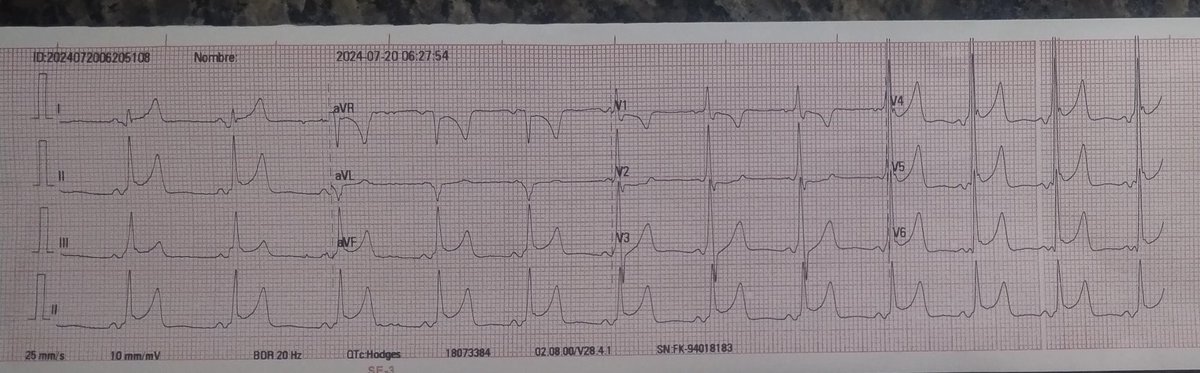 Victor_FragaE's tweet photo. - Se administra Bisoprolol 1.25 mg VO.
- Una hora posterior a su administración se toma el siguiente EKG
¿Diagnóstico? https://t.co/hgTErTIDj5