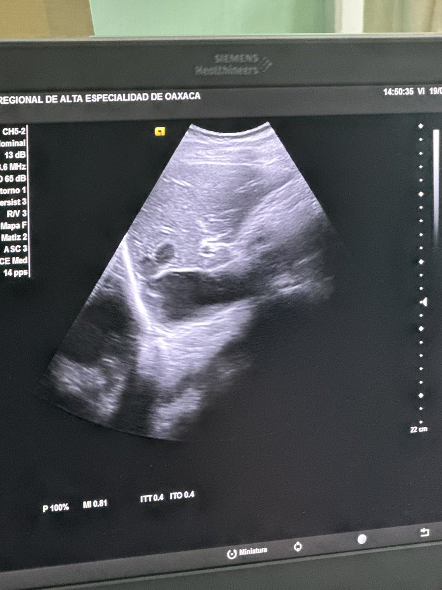 santiUCI's tweet photo. Vean esa vena cava inferior choncha de 3.3 cm…
@HRAEOAX 
@UNAM_MX  #PUEM
#ResidenciaMedicinaCrítica https://t.co/TTuPy2qZot
