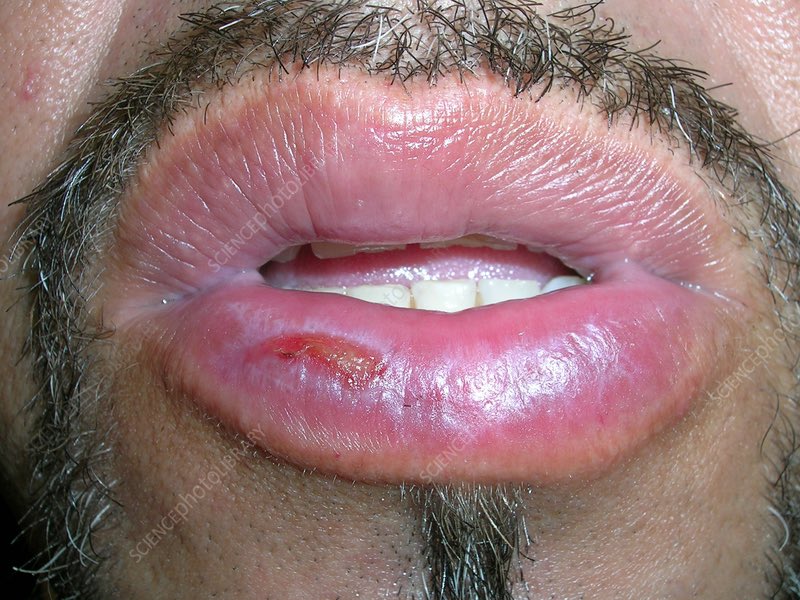 imaamir06's tweet photo. 38yo male with prolonged history of sun-exposure with lower lip swelling with scaling fissures and loss of vermillion borders. Findings gets worsened when he works outdoors 

Diagnosis ?
 
#dermatology #medicine https://t.co/oxSUYvl5R6