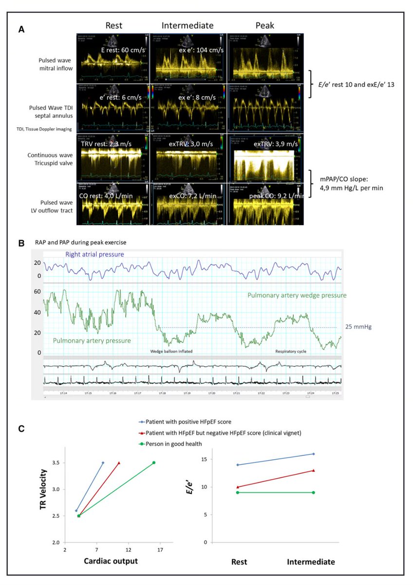SeguraCardio's tweet photo. 📌Clinical Significance of Exercise Pulmonary Hypertension w/ a Negative Diastolic Stress Test(DST) for Suspected #HFpEF

🔸⬆️ mPAP/CO slope might indicate #HFpEF irrespective of the DST result

#CircAHA https://t.co/DMREoq5jxA