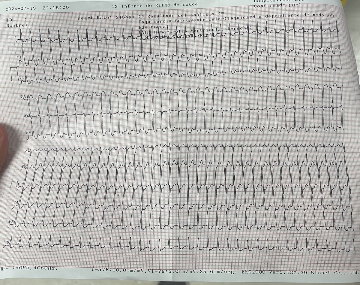 Victor_FragaE's tweet photo. - Masculino 18 años.
- Consumo de alcohol 24 horas previas a su ingreso
- Palpitaciones de 2 horas de evolución.
- Estable hemodinamicamente.

Este es su EKG de ingreso 
#EKG #ECG #Electrofisiologia #arritmia https://t.co/vrj58pAPjg