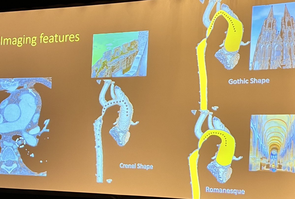 Happening now: imaging of aorta starting with an excellent overview of congenital aortic anomalies by <a href="/prachipagarwal/">Prachi Agarwal</a> moderated by <a href="/ayaz_aghayev/">Ayaz Aghayev</a>. <a href="/Heart_SCCT/">Heart_SCCT</a> #SCCT2024 <a href="/Nidhi_Madan9/">Nidhi Madan, MD, MPH</a> <a href="/rishk88/">Rishabh Khurana</a> <a href="/Kfarooqi/">Dr. Kanwal M Farooqi</a> <a href="/anjali_chelliah/">Anjali Chelliah</a> <a href="/sgcard/">Sunil Ghelani</a>