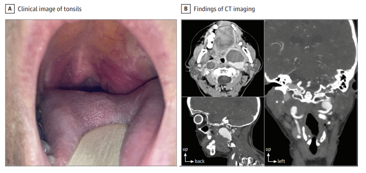 JAMAOto's tweet photo. A 60-year-old patient presented with odynophagia and dysphagia. Upon clinical examination, a left-sided erythematous oropharyngeal bulging was observed. A puncture was performed revealing dark bloody fluid. A CT scan was conducted.

What is your diagnosis? https://t.co/RhQYGfm1k5 https://t.co/O54bHASIU4