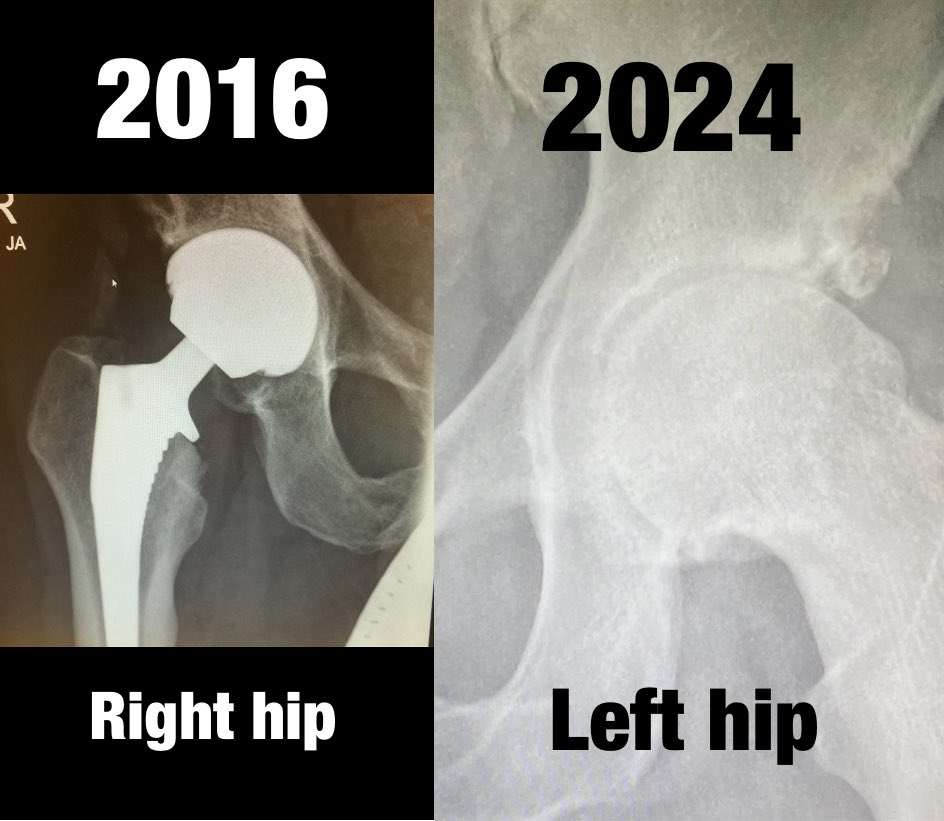 TheDavidWeck's tweet image. “Conventional” training destroyed my hips. 
I’m defining “conventional” as that which does NOT root to Balanced Locomotion. 
I was taught/instructed “stiff straight spine” gait. 
“Don’t let your head move” was the foundation they said. 

The damage was done before I figured out…