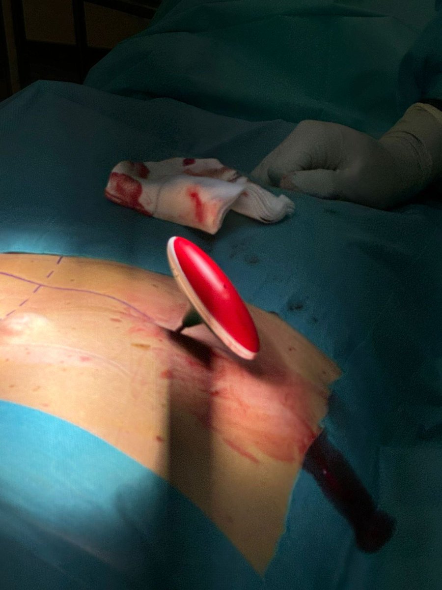 Os presentamos el primer caso en España de radiofrecuencia ablativa del nervio basivertebral, que hemos realizado con el Dr. Bruno Lourenço Costa y StimHealth Medical en el Hospital Quirónsalud Juan Bravo.

davidabejon.com/radiofrecuenci…