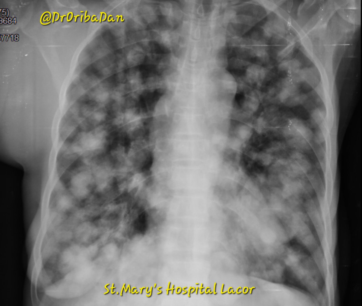 52yrs/F with weight loss, DIB, abdominal distention. 
🤔How can we encourage them to come early for preventive checkup or screening.
🤨What are your Differentials 
<a href="/Lung_Institute/">Makerere University Lung Institute</a> <a href="/MakCHS_SOM/">Makerere University School of Medicine</a> <a href="/InternalmedMak/">Internal Medicine Residents @Makerere</a> <a href="/rkalyes1/">Robert Kalyesubula,MD, FISN(USA), PhD-FRCP(London)</a> <a href="/ainbyoo/">Ainebyoona Emmanuel</a> <a href="/MinofHealthUG/">Ministry of Health- Uganda</a>  <a href="/andrewsuleh/">Dr Andrew Suleh MD</a> <a href="/UgandaPhysician/">Association of Physicians of Uganda</a>