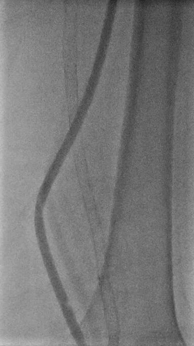 Marco Shaker (@marcoshakeric) on Twitter photo #Power_pulse_technique w #tPA to revasc 600mm #Femoral #CTO w #occluded bypass in Pt with #threatened_limb_loss. #limbsalvage #rotarex #powerpulse #stopthechop <a href="/JaafGolzar/">Jaafer Golzar MD FACC, FSCAI</a> <a href="/AdhirShroff/">Adhir Shroff</a> <a href="/mividovich/">Mladen Vidovich</a> <a href="/jbspadoni/">Joaquim Spadoni Barboza</a> <a href="/spiritus_bah/">Amer Ardati</a> <a href="/KhalilIbrahimMD/">Khalil Ibrahim</a> <a href="/UIC_CathLab/">UIC Cath Lab</a> #Finger_of_God #Power_pulse_technique w #tPA to revasc 600mm #Femoral #CTO w #occluded bypass in Pt with #threatened_limb_loss. #limbsalvage #rotarex #powerpulse #stopthechop <a href="/JaafGolzar/">Jaafer Golzar MD FACC, FSCAI</a> <a href="/AdhirShroff/">Adhir Shroff</a> <a href="/mividovich/">Mladen Vidovich</a> <a href="/jbspadoni/">Joaquim Spadoni Barboza</a> <a href="/spiritus_bah/">Amer Ardati</a> <a href="/KhalilIbrahimMD/">Khalil Ibrahim</a> <a href="/UIC_CathLab/">UIC Cath Lab</a> #Finger_of_God