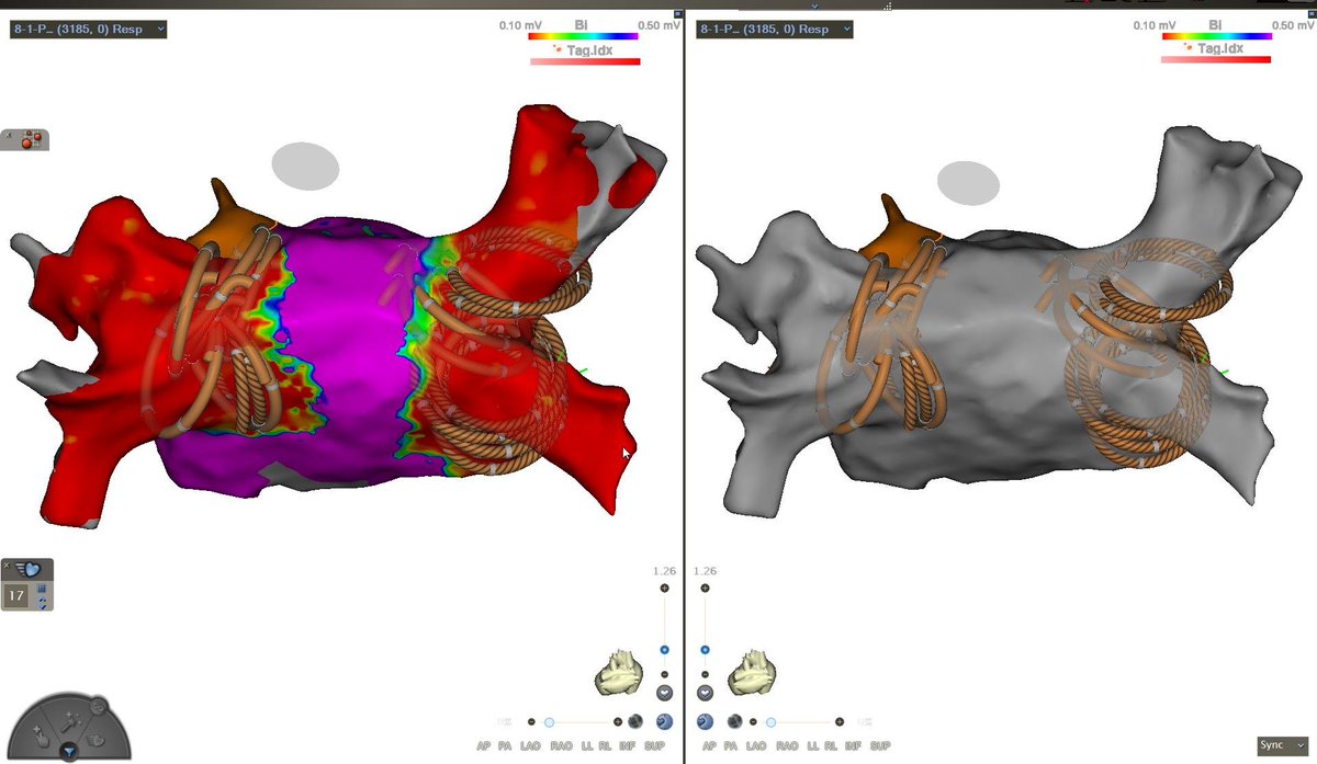 Is mapping necessary when using PFA to treat AF? It definitely makes delivery of ablation lesions much more predictable and avoids narrow isthmus on posterior wall.