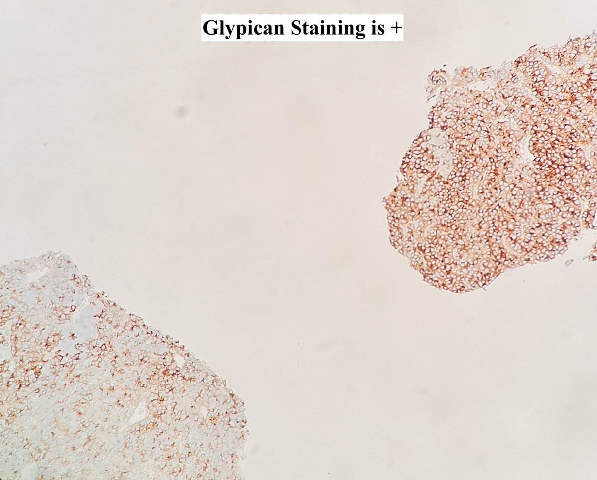 Hepatocellular Carcinoma

•75-85% of 1°Liver Ca.
•>95% have cause (eg. Hep B/C, steatohepatitis from EtOH or metabolic syndrome, hemochromatosis, aflatoxin)
•4🔬patterns: trabecular; solid; pseudoglandular; macrotrabecular (>/= 10 cells; worse prog.)
•8 subtypes

#pathagonia