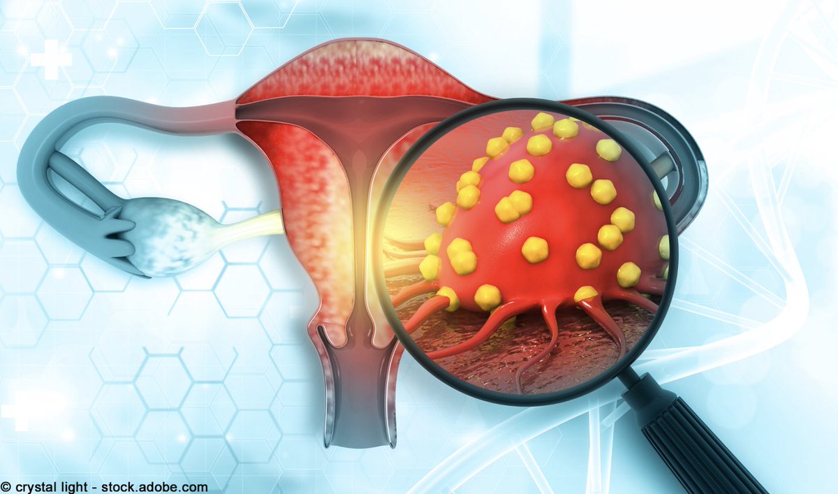OncLive's tweet photo. Dostarlimab plus chemotherapy significantly improved OS in advanced or recurrent endometrial cancer, with a median OS of 44.6 months vs 28.2 months for placebo. @SarahCannonDocs @myESMO #ESMOGYN24 #gynsm #oncology https://t.co/utRT1raREr https://t.co/5BaXn99HSY