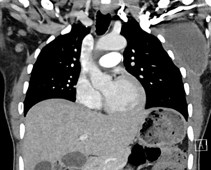 30 y/o w/ chronic back pain presents w/ worsening back &amp; pelvic pain as well as leg weakness, what is the most likely diagnosis?

🔷Additional findings on CT chest 👇 
🔷Malignancy work up negative

More images in 🧵
#meded #neurosurgery #neurology #medicine #radres #futureradres