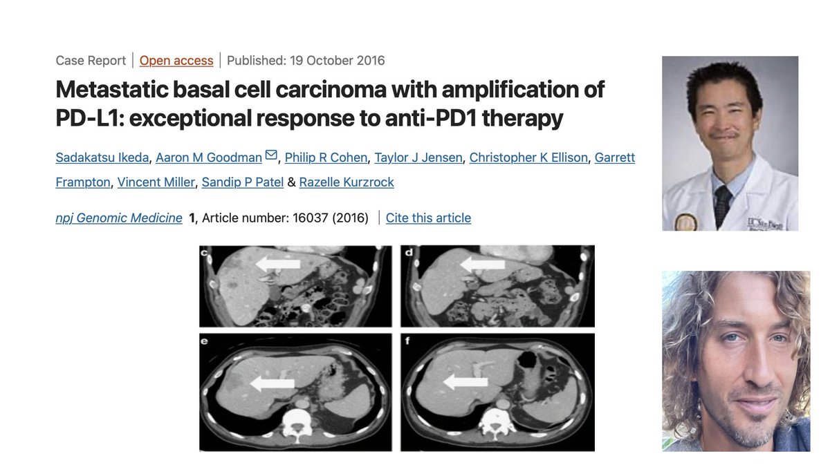 Razelle Kurzrock, MD (@dr_r_kurzrock) on Twitter photo In 2015 we treated this pt (refractory basal call ca, metastatic liver, bones, brainā in wheelchair) with nivolumab
High TMB, PDL1 amp
In CR 8.5+ years
ā¦<a href="/AaronGoodman33/">Aaron Goodman - āPapa Hemeā</a>ā© In 2015 we treated this pt (refractory basal call ca, metastatic liver, bones, brainā in wheelchair) with nivolumab
High TMB, PDL1 amp
In CR 8.5+ years
ā¦<a href="/AaronGoodman33/">Aaron Goodman - āPapa Hemeā</a>ā©