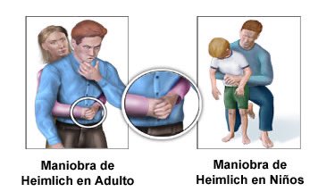 martincarrizo_'s tweet photo. Maniobra de Heimlich para personas que se están AHOGANDO con objetos o comidas. IMPORTANTE CONOCERLA PARA QUE NO SUCEDA ESTO:

1• Identificar cuando la persona se está ahogando:
 
No puede hablar, no puede toser ni respirar. Suele llevarse la mano al cuello como una señal de que se está ahogando. O muestra su cara colorada o incluso azulada.
  
2• Pararse detrás de la persona adulta o, si es un niño, arrodillarse detrás del mismo (ver fotos).

3• Colocar manos de esta manera:
 
Hacer un puño con una mano y apoyar el lado del pulgar del puño contra el abdomen de la persona, entre el ombligo y el tórax. Se cubre el puño con la otra mano.

4. Realizar compresiones abdominales, presionando el abdomen con un movimiento rápido hacia adentro y hacia arriba
Repetir hasta que el objeto se expulse. Interrumpir luego de 10 veces y dar golpes en la espalda alta con las palmas de la mano.
Luego volver.

5• Si la persona está embarazada, presionar entre la panza y el tórax.

6• Hacerlo hasta que la persona pueda respirar. Si pierde el conocimiento, seguir con RCP mientras se llama a emergencias.

Ténganlo en cuenta. Puede salvar una vida.