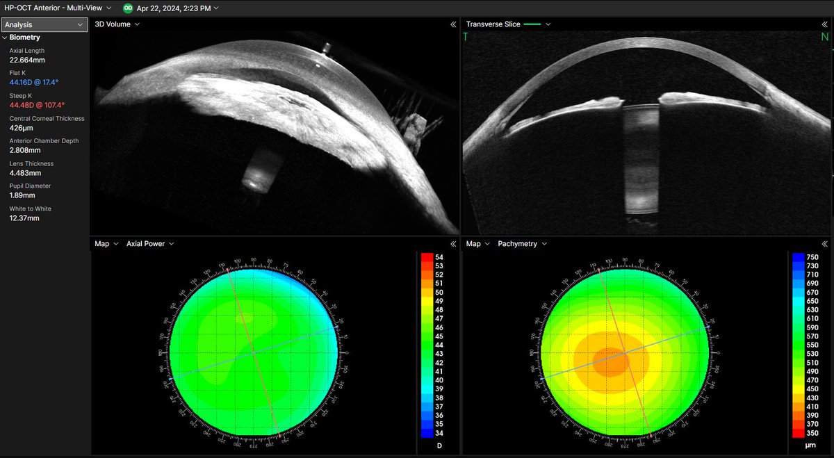 CyliteOptics's tweet photo. Loved hosting some leading local optometrists, interested in learning more about our Hyperparallel OCT and how this will benefit their clinic and patients alike. 
Thanks to all who came along. 
#sclerallenses #optometryaus #keratoconus #orthoK #HP-OCT #OCT #topography #myopia https://t.co/VxA3Dz8R2z