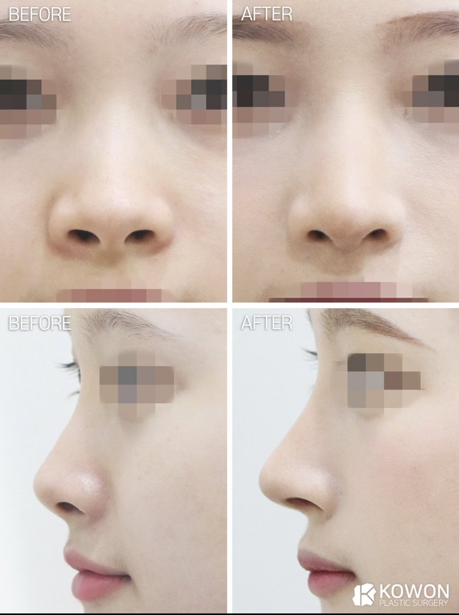 datcha_memo's tweet photo. ナチュラルな忘れ鼻にしたい人はコウォン👃「なんか変わったよね？でもどこだろ？」と周りにバレたくない人向け🙆‍♀️✨ 価格は肋軟骨使わずに50万くらい！どこのクリニックも肋をいれると鼻フルは価格上がります🥺10万くらい+のイメージ💸 https://t.co/jYHbtdfkoi