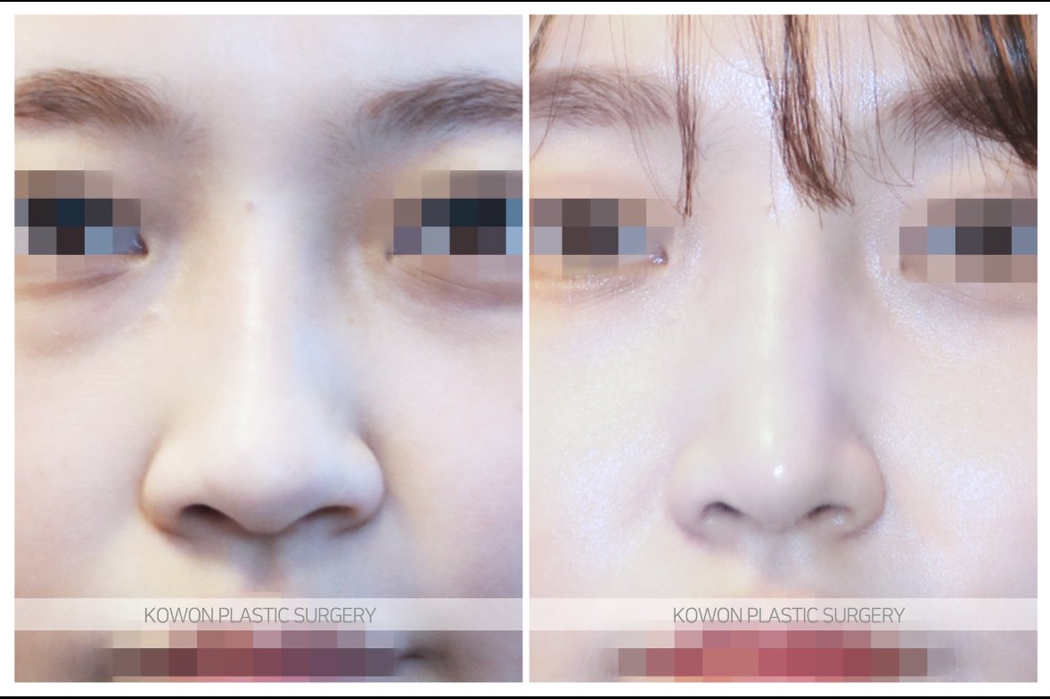 datcha_memo's tweet photo. ナチュラルな忘れ鼻にしたい人はコウォン👃「なんか変わったよね？でもどこだろ？」と周りにバレたくない人向け🙆‍♀️✨ 価格は肋軟骨使わずに50万くらい！どこのクリニックも肋をいれると鼻フルは価格上がります🥺10万くらい+のイメージ💸 https://t.co/jYHbtdfkoi