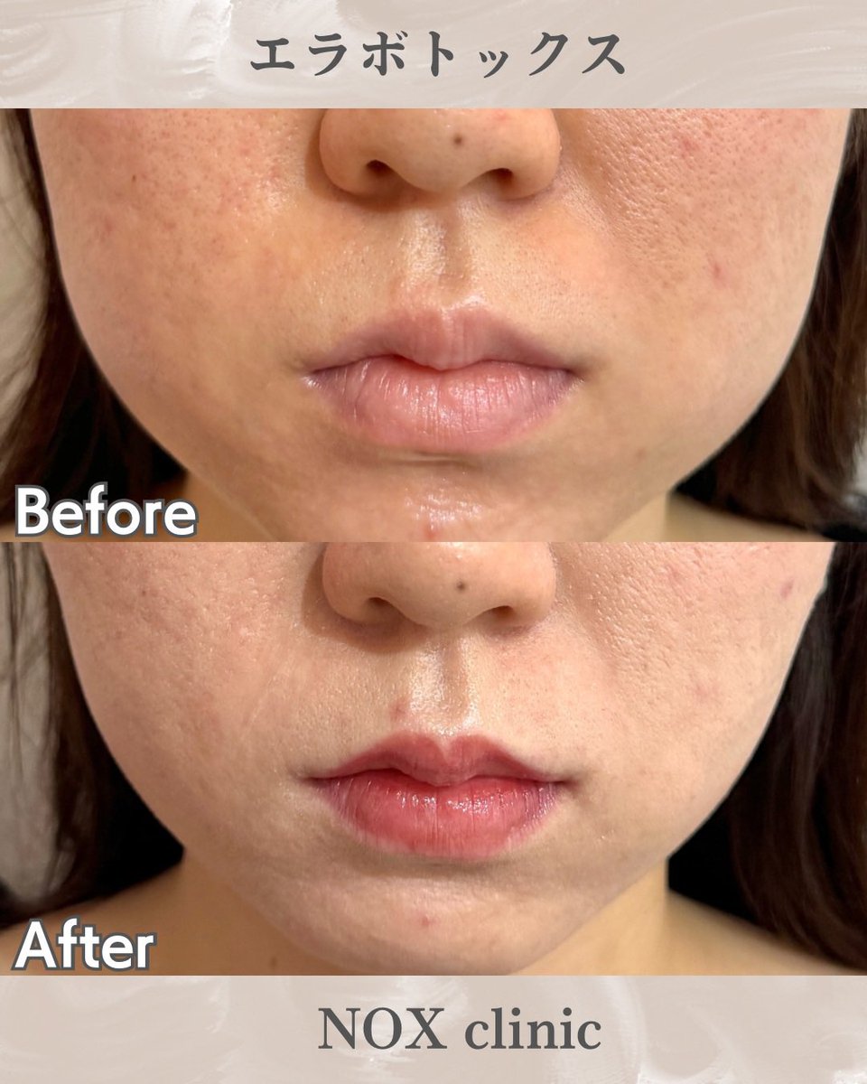 エラボトックスで
気をつけないといけないことは
頬コケをおこさないようにすること。
この時期は夏バテで食事量が減って
頬がコケやすい方もいるから
そういう部分にまで配慮して
施術を行っています。
ボトックスって
ただ打つだけではないんです。

エラボトックス
100単位、1回施術の
症例です