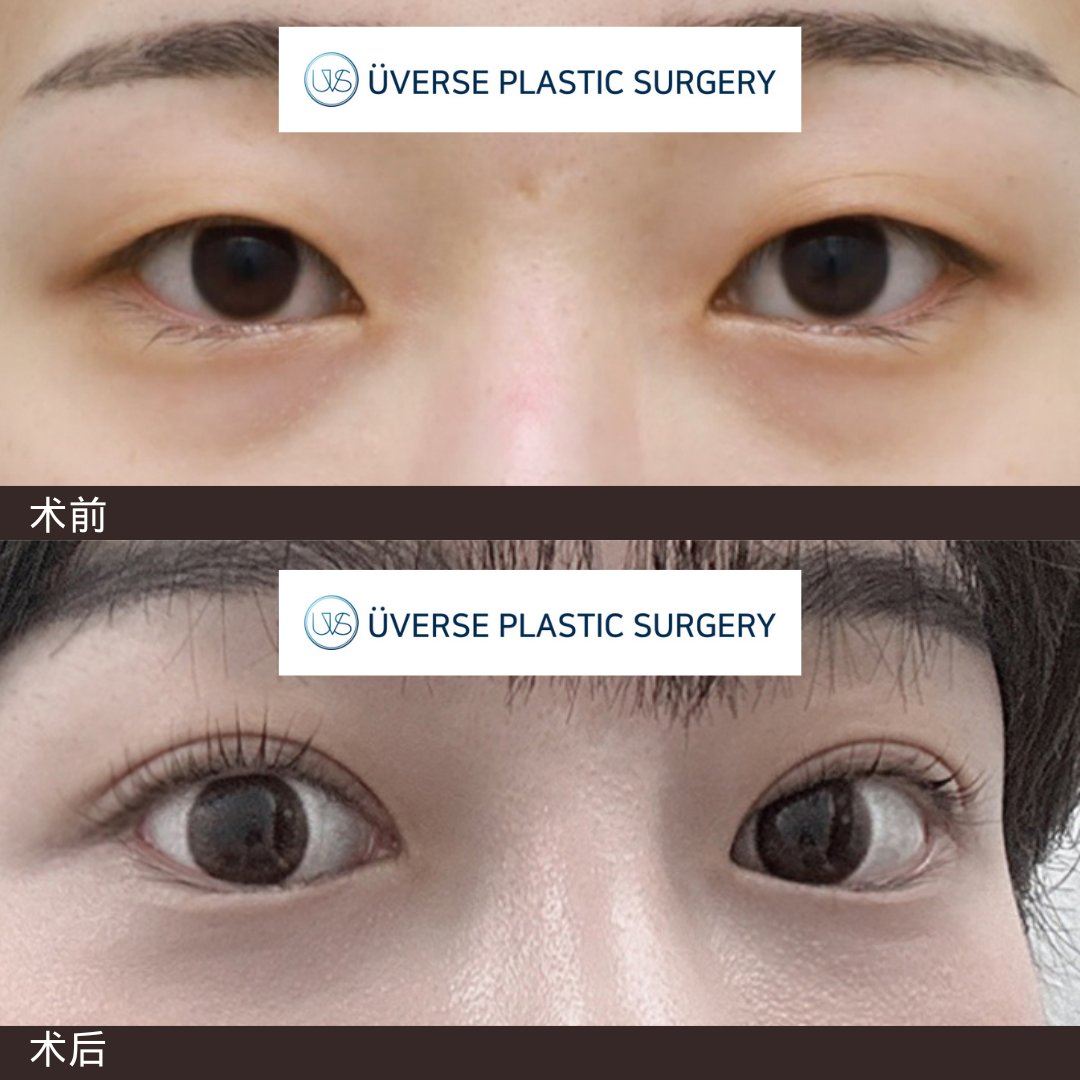 清潭es整形外科眼整形怎么样?分层剥离技术加持,自然无痕体验好-非常爱美网, image size:1080x1080