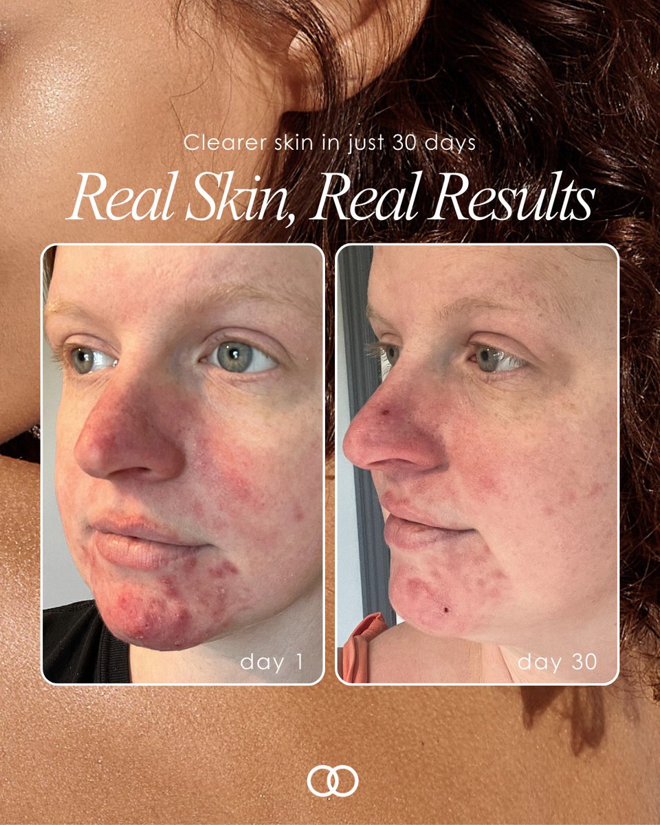 ProjectEBeauty's tweet image. Swipe right to meet the skincare hero behind this transformation 👆🏼

Excited to start your own skincare success story? 

Drop your concerns below, and we&apos;ll send you personalized product recs!  💬✨
.
.
.
#BreakoutControl#AcneSolutions#Hyperpigmentation