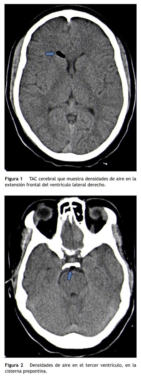 _REDAR_'s tweet photo. Neumoencéfalo tras colocación de catéter epidural... 2ml de aire bastan‼️
Puedes leer la revisión a propósito de un caso aquí 👇🏻👇🏻👇🏻
https://t.co/Cztpez0DOp https://t.co/gy6kK5q4OZ