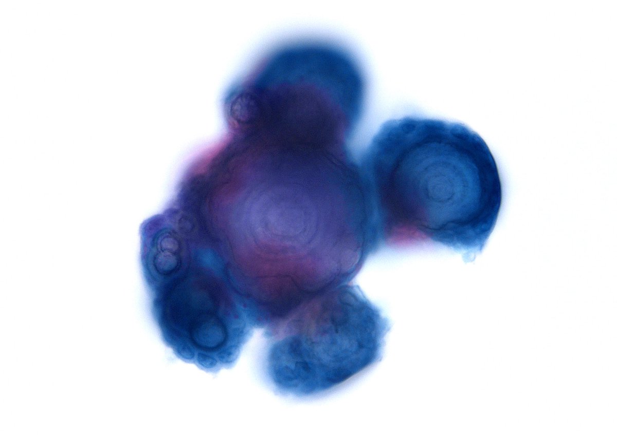sza_jhcyto's tweet photo. “They come in all sizes and shapes” - Psammomatous Effusion, Abdominal, in a patient with Ovarian Serous Carcinoma. (Cytospin) https://t.co/SO0XyCNcS1