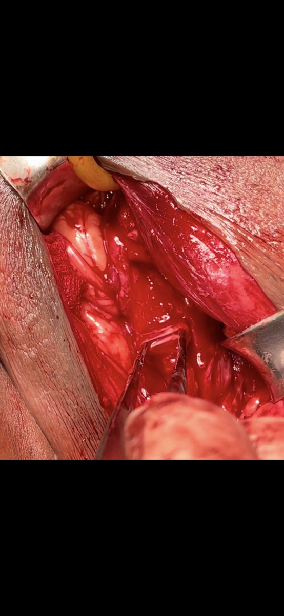Just when you thought you’ve seen everything. Today we anastomosed a 3-4cm segment of the urethra that was transected four months ago during a varicocelectomy