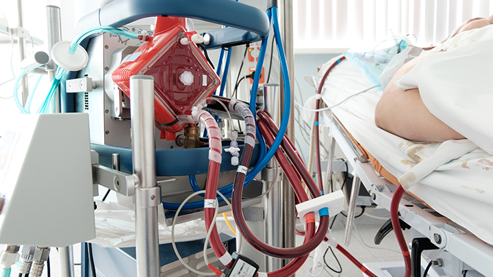 An exploration of intensive care nurses’ perceptions of workload in providing ECMO support: A descriptive qualitative study #Openaccess editor's choice @ICUnurses@jaynesheldrake@jasonwatto@danielleberko@IntensiveDave@chodgsonANZICRC
australiancriticalcare.com/article/S1036-……