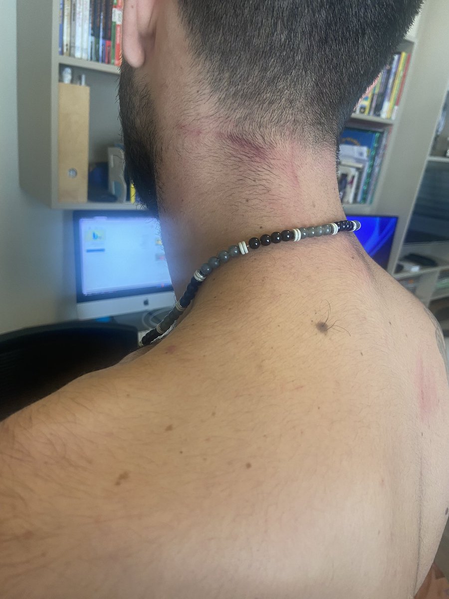 IVugalter's tweet photo. ככה נראה בן אדם שהוכנס לניידת משטרה באלימות רק כי רכב על קורקינט בלי קסדה.
כמובן שהשוטרים לא נשאו מצלמות.
האירוע קרה בפנקס 48 בסביבות השעה 11:30, עמית עוכב בניידת תקופה ארוכה כך שלא יכל לקבל את הסרטונים המתעדים את האירוע, תפיצו כדי שמי שהאירוע מוכר לו ישלח לנו את התיעוד! https://t.co/oyPjm0Gd4e