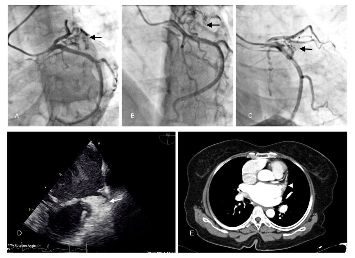 InvasiveCardiol's tweet photo. 🆕 July issue available now! https://t.co/64h3P6AfKY
@DLBHATTMD @ChahineJohnny @KaranRKalani @CTVS_AARHUS @ALadwiniec @dnzmtlu @anoop_alberta @Jonyap88 @YMurasato @RempakosT @m1chaella_alex @AhmedAlOgaili @LAzzaliniMD #cardioTwitter #cardioX #cardiology #interventionalcardiology https://t.co/7MSVRK7hUV