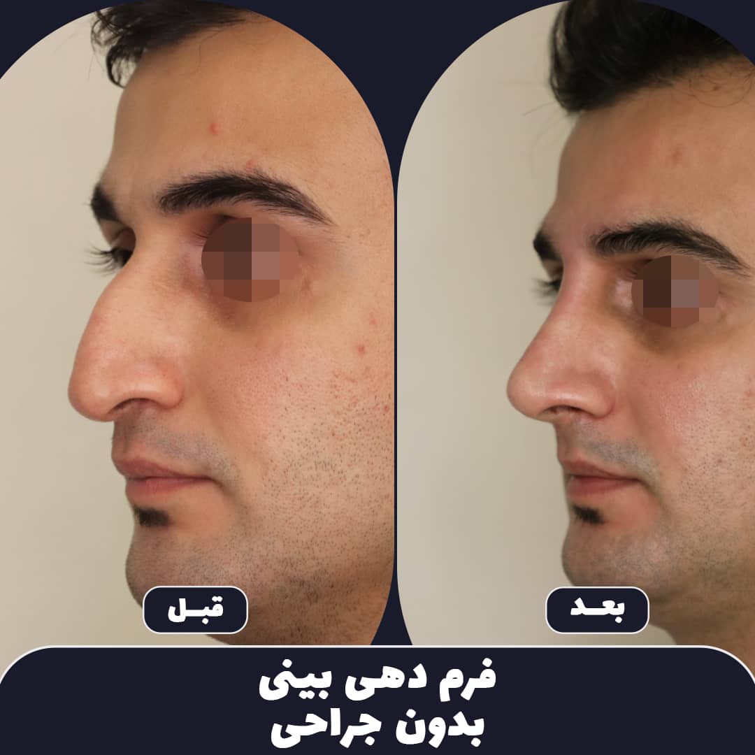 Arman_elahie's tweet image. با نخ هم می توان سر بینی را بالا کشید و هم پوست را جلو کشید و رفع قوز کرد. ولی اگر فردی بینی فانتزی و سربالا می خواهد بهتر است جراحی کند که دکتر خواجه رحیمی فوق تخصص جراحی پلاستیک در کلینیک ما حضور دارند.
#لیفت_بینی #لیفت_بینی_با_نخ #nosethreadlift #noselift