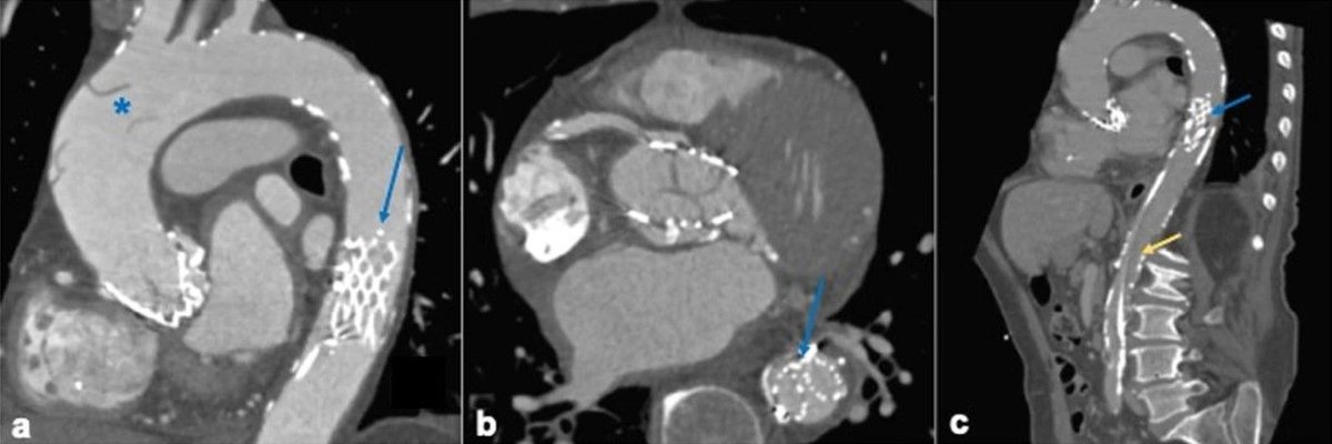 Insights into Imaging (@insightsimaging) on Twitter photo Educational Review: CT imaging post-#TAVI - Murphyās first law in actionāpreparing to recognize the unexpected. (Costanza Lisi et al., <a href="/Figliozzis/">Stefano Figliozzi</a>)
#InsightsIntoImaging
š buff.ly/3RW6QaN Educational Review: CT imaging post-#TAVI - Murphyās first law in actionāpreparing to recognize the unexpected. (Costanza Lisi et al., <a href="/Figliozzis/">Stefano Figliozzi</a>)
#InsightsIntoImaging
š buff.ly/3RW6QaN